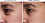 Лазерное устройство TRIA Age-Defying Eye Wrinkle для омоложения кожи вокруг глаз